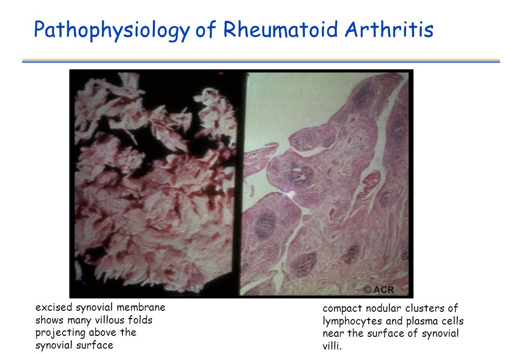 Rheumatoid arthritis physiology